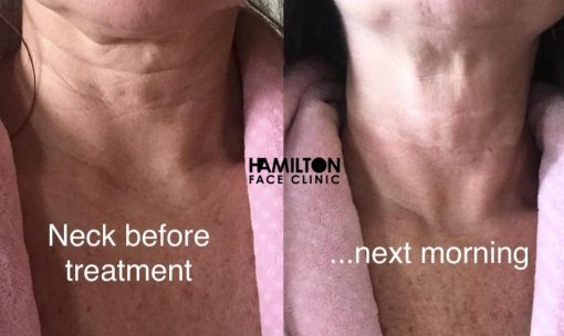 Before and after Neck Profhilo
