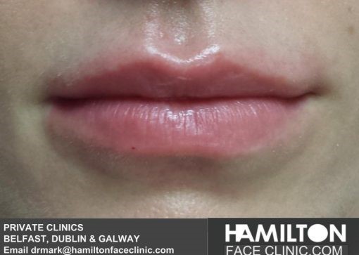 Lip Filler by Dr. Mark Hamilton 